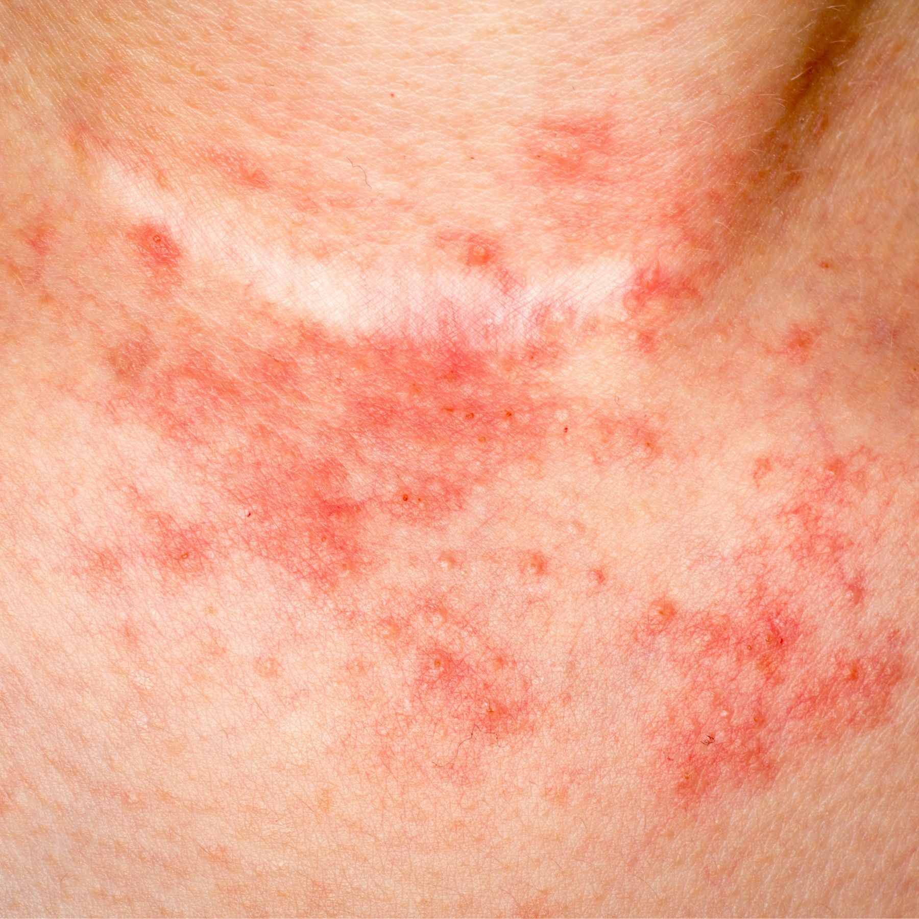 What Is Reactive Skin — and Why Does It React to Everything?